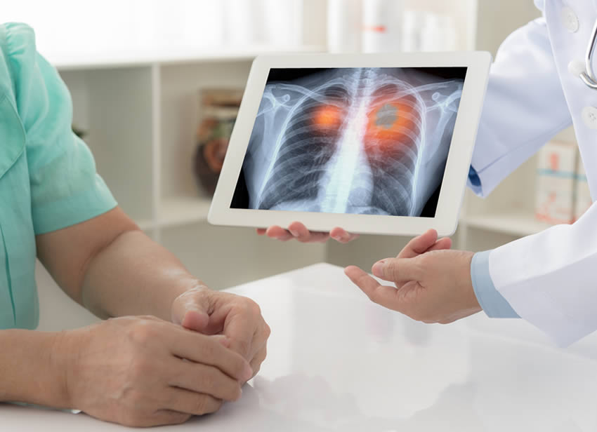 Mesothelioma Cases